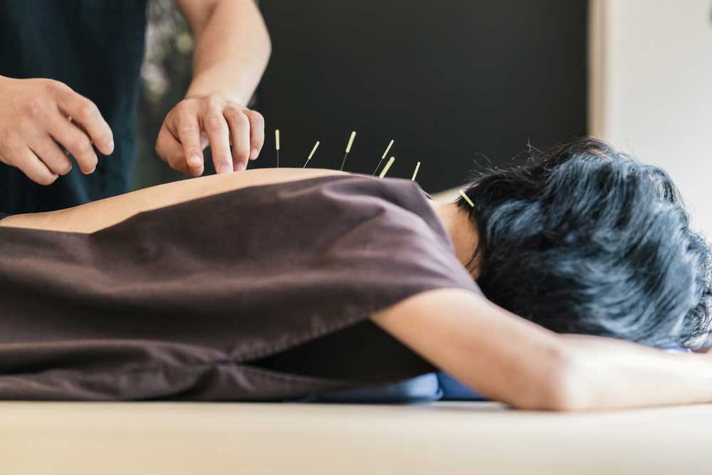 Séance d'acupuncture